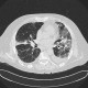H1N1, atypical pneumonia, superinfection: CT - Computed tomography
